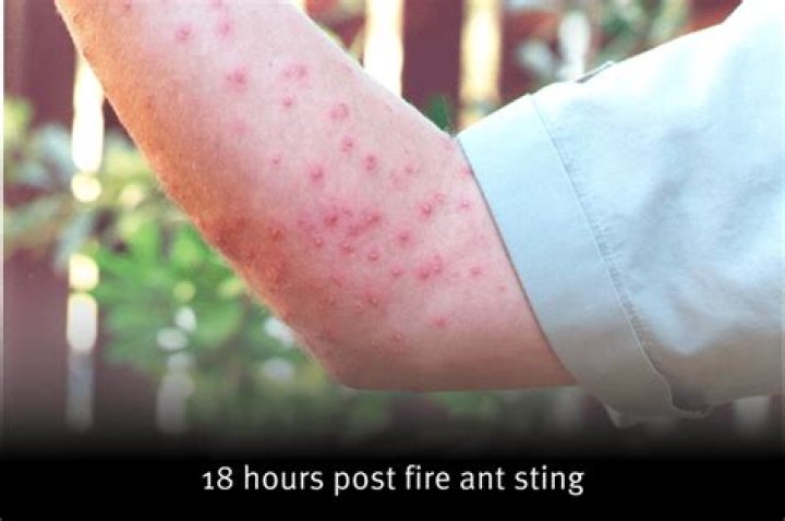 Can ants bite you in bed?