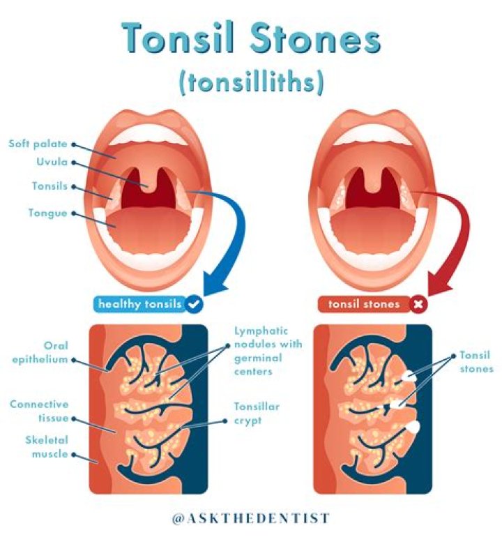 Do tonsil stones make you cough?