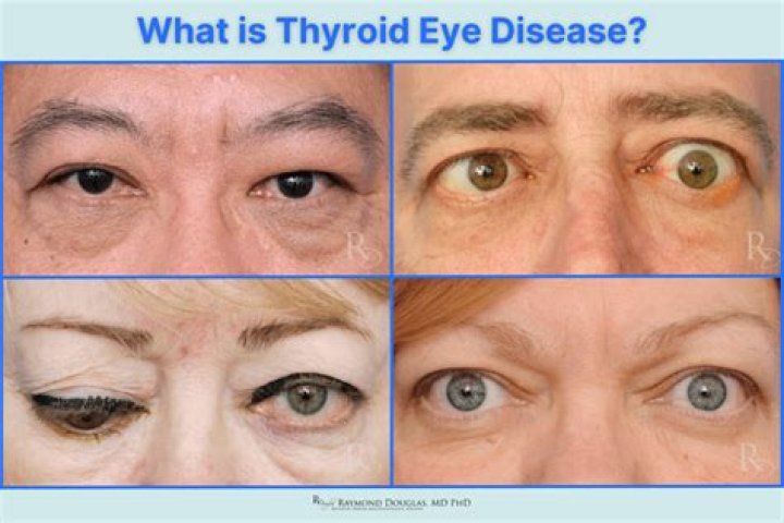 Does thyroid issues affect your eyes?