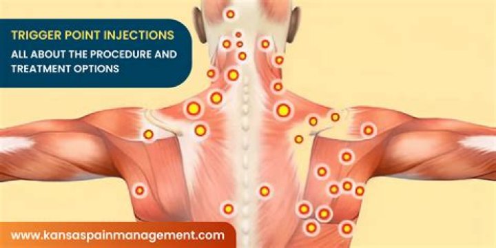 How often can you get trigger points?
