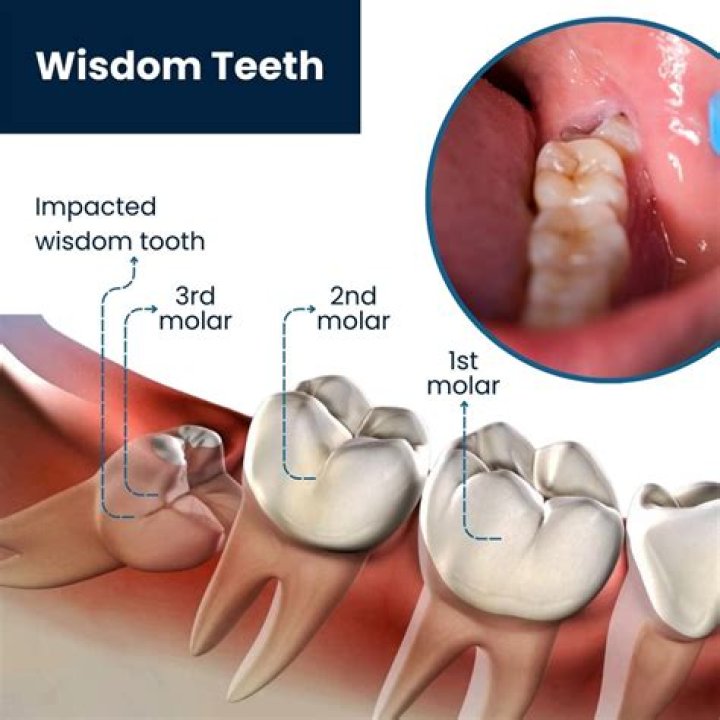What do dentist do with wisdom teeth?